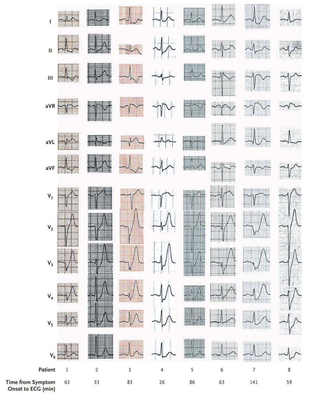 一文说清!7 种易被忽视的高危心电图表现
