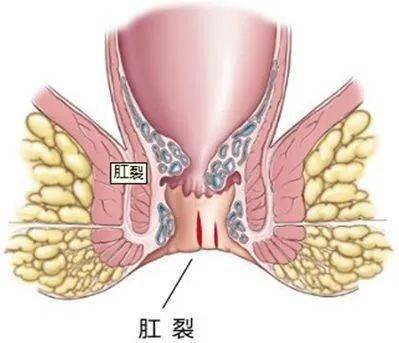 肛裂赘生物图片图片