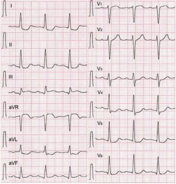 心电图rv6十sv2正常值图片