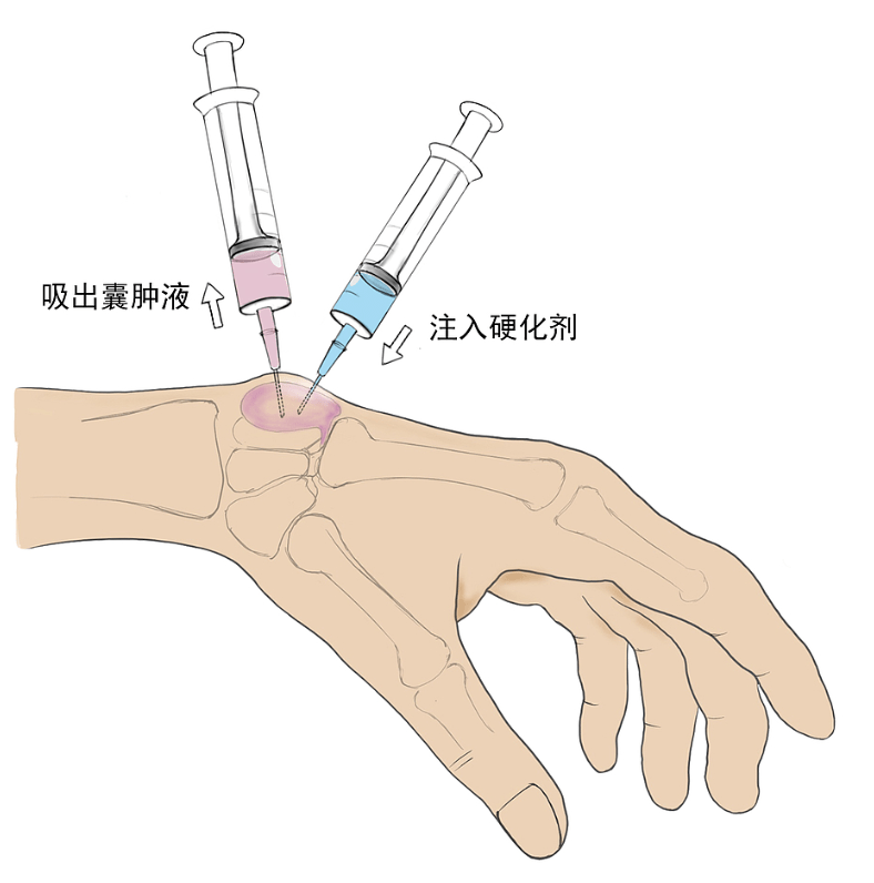 手腕腱鞘囊肿手术过程图片