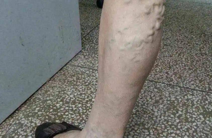 静脉曲张常开始于妊娠第3个月,分娩后减轻,但不能消失.