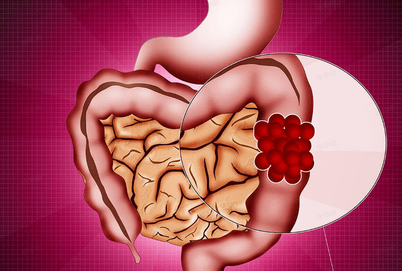 听我一句:肠息肉不想变肠癌,3种东西劝你少吃,再馋也要忍住_风险_肠道