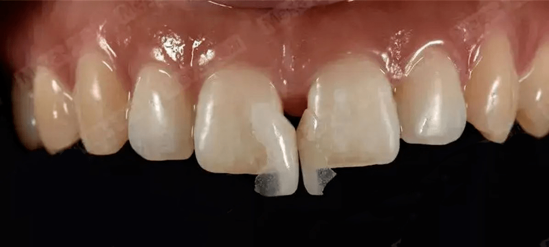 牙缝大,不再是烦恼,瓷贴面帮你关闭牙缝!_牙齿_患者_形态