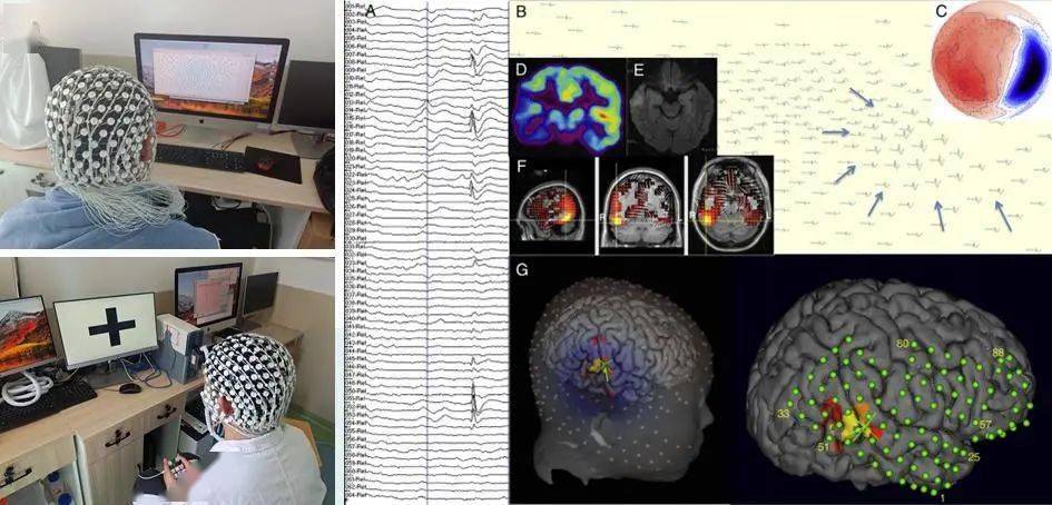 egi脑电图片