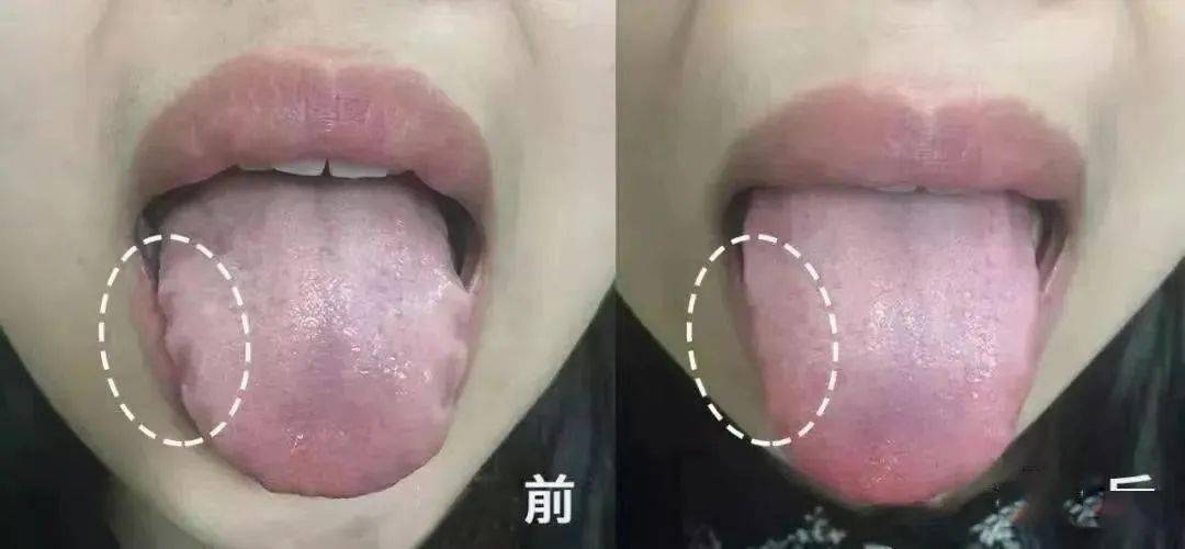 连续喝了几周,觉得精神好了很多,早晨不困倦,裙边舌没有了.