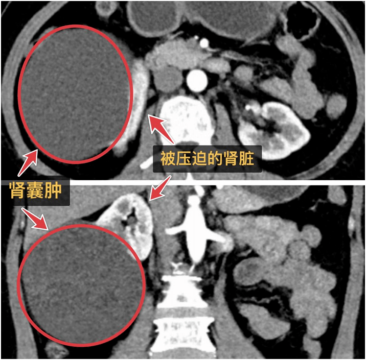 体检发现肾囊肿