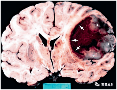 小脑坏死图片