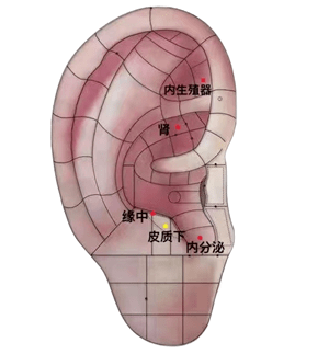 常用耳穴如内生殖器,内分泌,皮质下,肾,缘中等.
