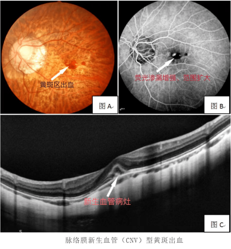 高度近视是"病",不只是戴厚镜片那么简单_视网膜_眼底_检查