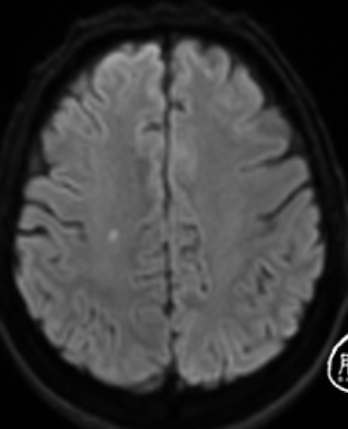 頭顱mri平掃:1,左側側腦室旁,左側基底節區亞急性腦梗死;2,右側外囊
