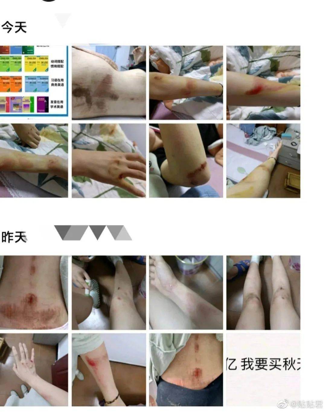 回过神的女生被送去了医院,此时的她早已遍体鳞伤.