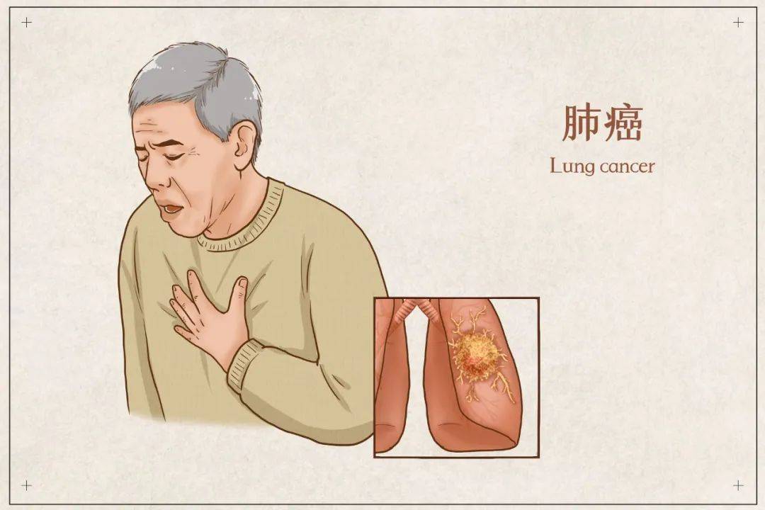 肺癌早期症状表现图片