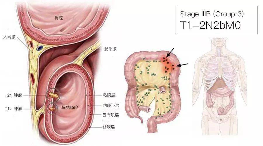 一文了解结直肠癌tnm分期