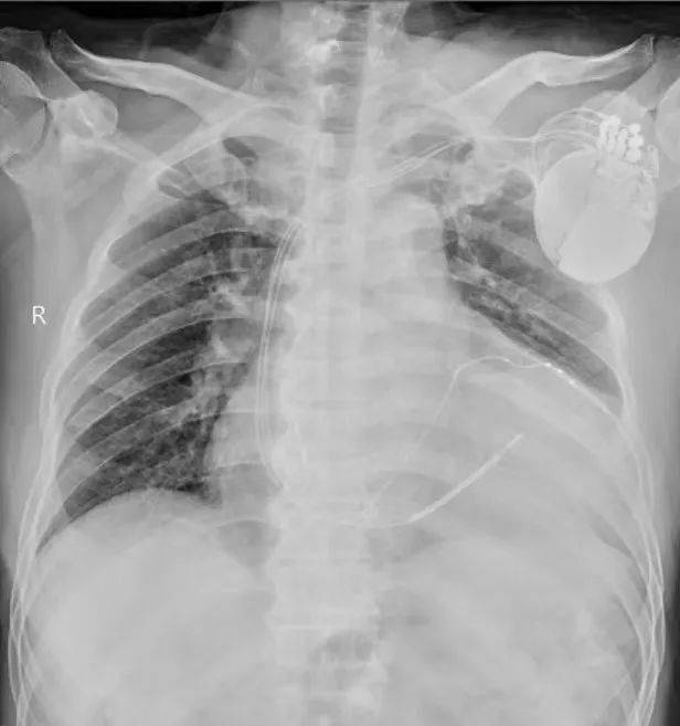 crt-d改善心衰患者的心脏功能,提高运动耐量以及生活质量,是心力衰竭