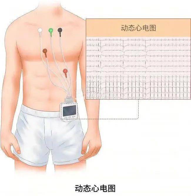 接受holter检查前需要知道的知识