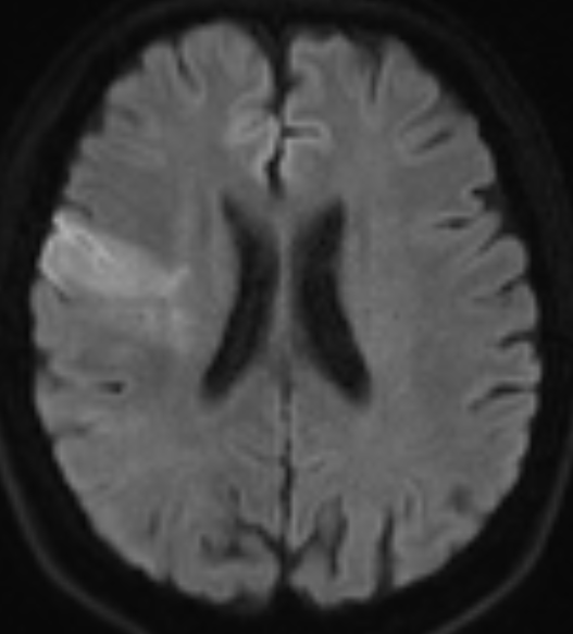 右側額顳葉新發梗死.術前dwi adc:未見出血,aspects-ct 10分.