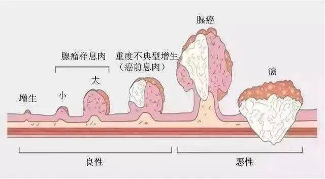 消化道癌科普 