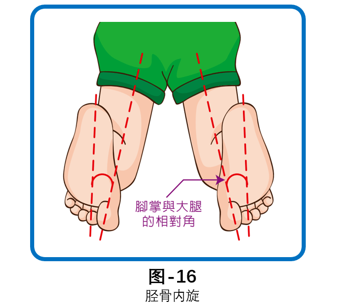 ③ 腳掌內收前掌內收也可導致