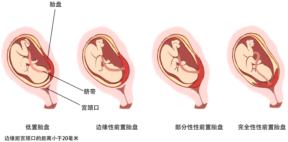 正常胎盘位置图片图片