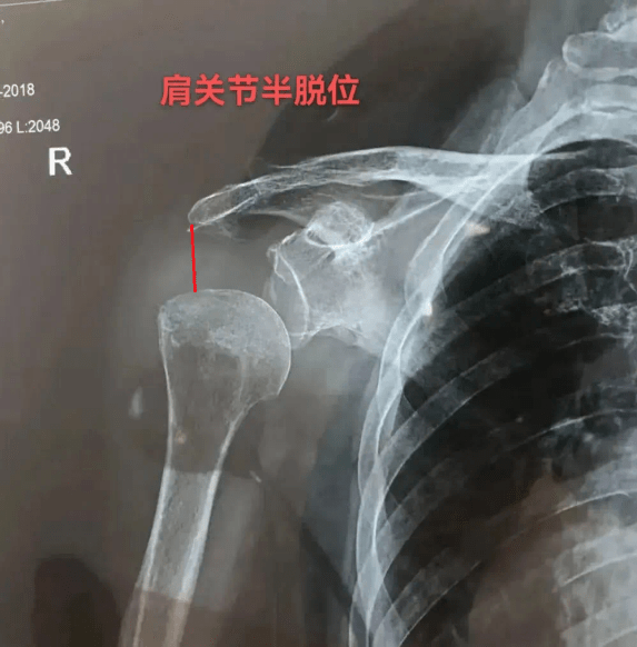 【医文医话】康复中心:脑卒中碰上肩关节半脱位怎么