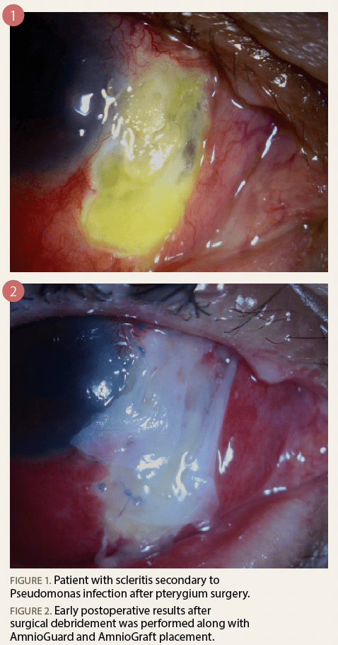 宫颈癌褐色分泌物图片图片