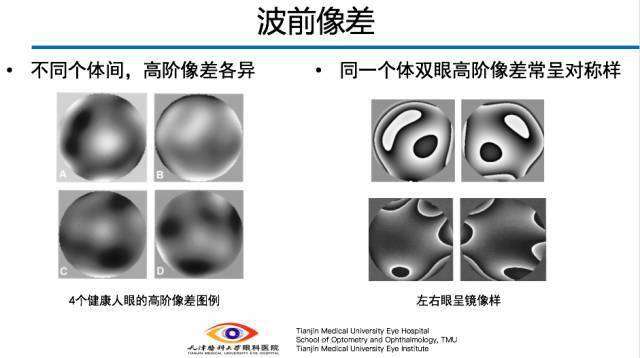 【眼視光】人眼波前像差_角膜_屈光_晶體