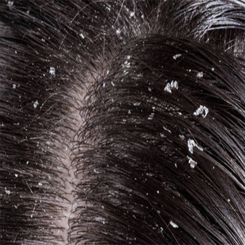 头发_头皮屑_成分