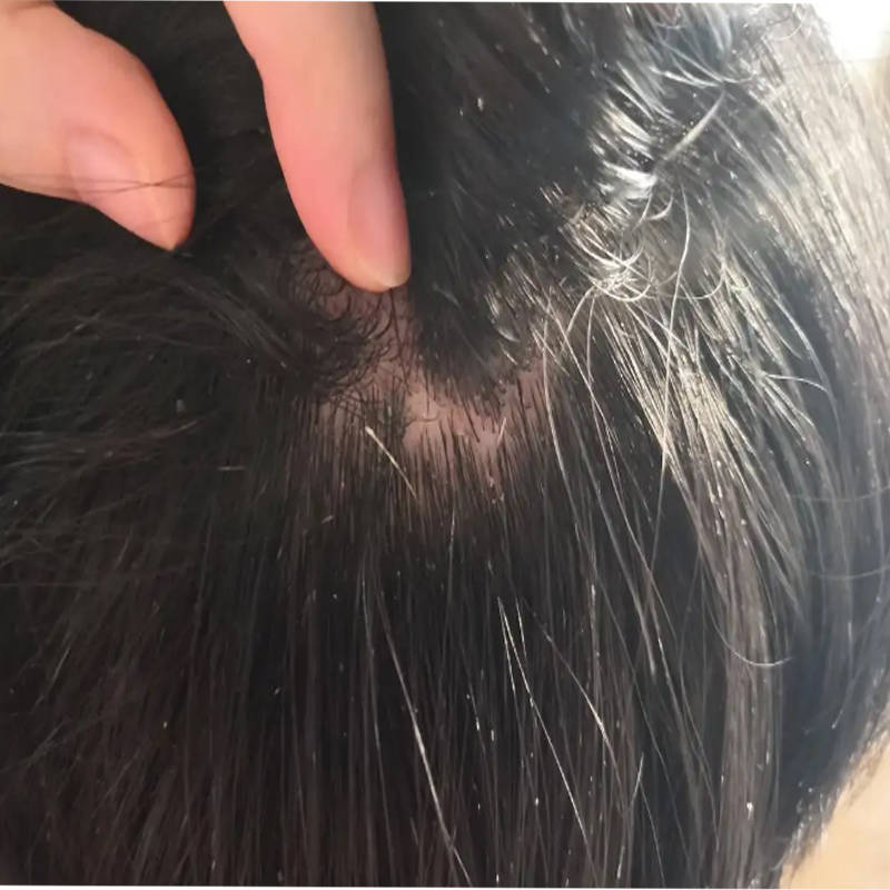 去屑去螨虫的洗发水推荐_头发_头皮_成分