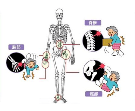 【湯醫科普】雪天路滑,老年人需腳下