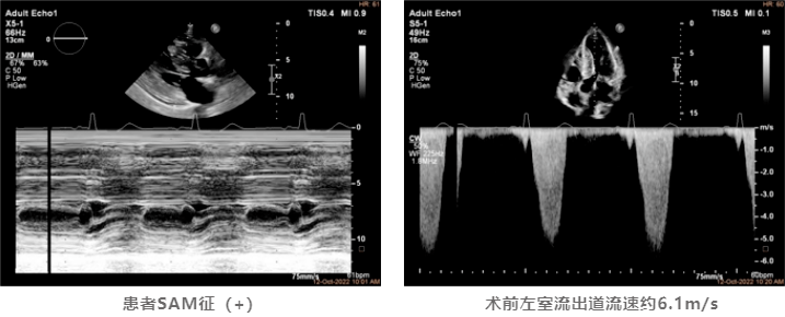 突破|經導管肥心病消融術成功完成10例探索性臨床應用_患者_mmhg_心肌