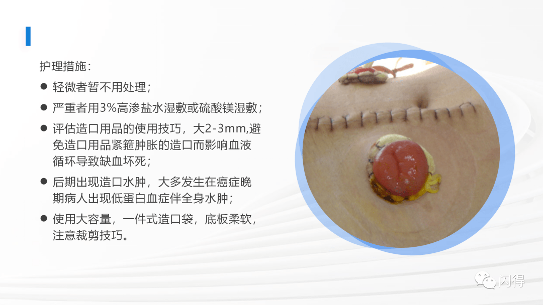 【ppt】肠造瘘术后患者护理