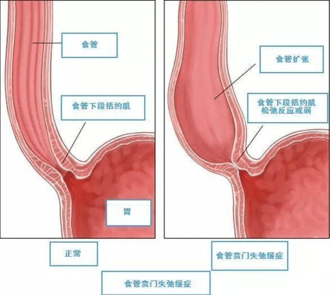 贲门部位在哪个位置图片