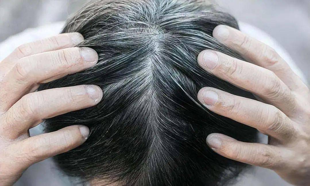 哈佛研究:长白头发的人不易患癌?是真的吗_白发_癌症_毛囊