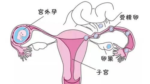 输卵管图片 宫外孕图片