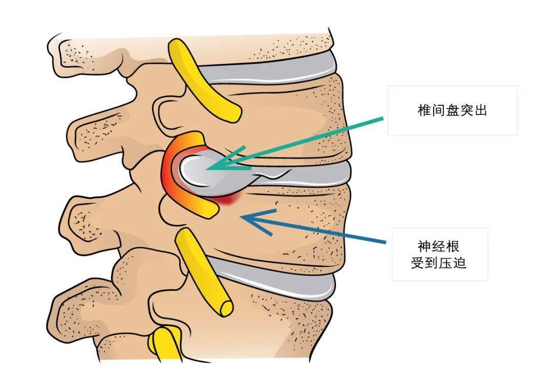 脊神经根分布图图片