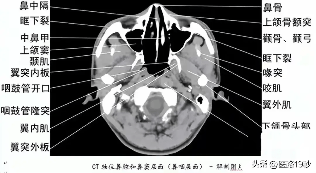 正常人鼻骨ct图图片