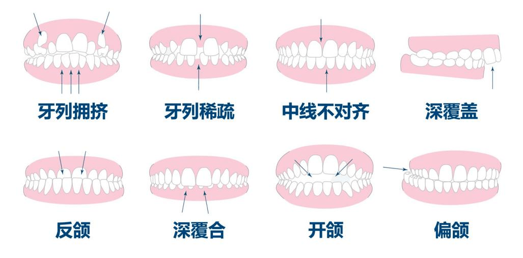 ③ 各種類型的牙套,如功能矯治器,金屬牙套,隱形牙套,保持器等.