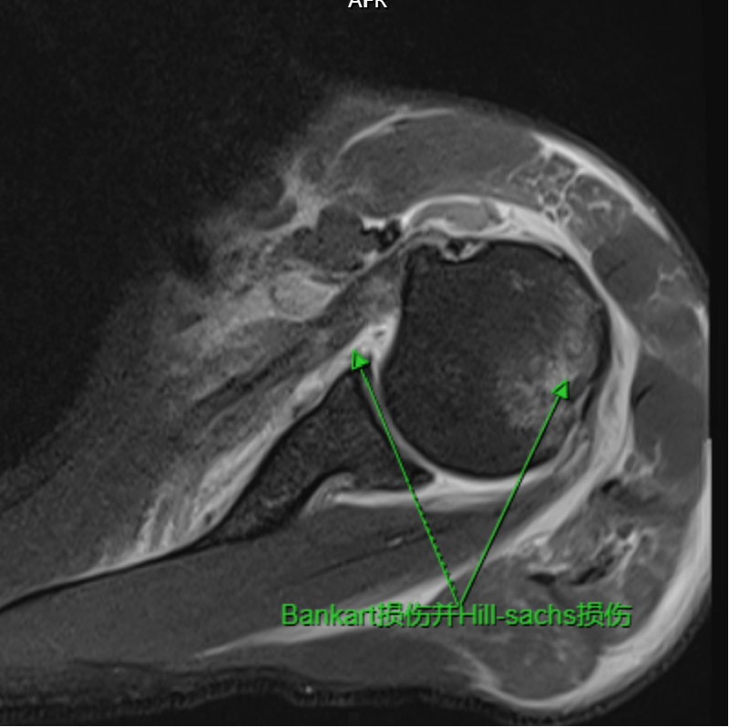 全關節鏡下bankart損傷(關節盂前唇撕裂)修補及巨大肩袖撕裂修補術,術