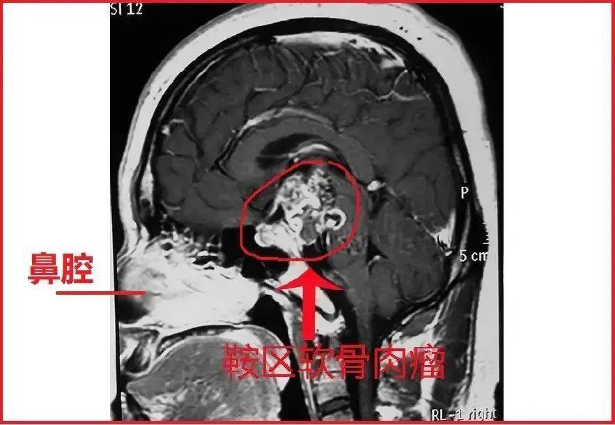 醫護人員竟將胃管插入病人大腦!_操作_臨床_禁忌症