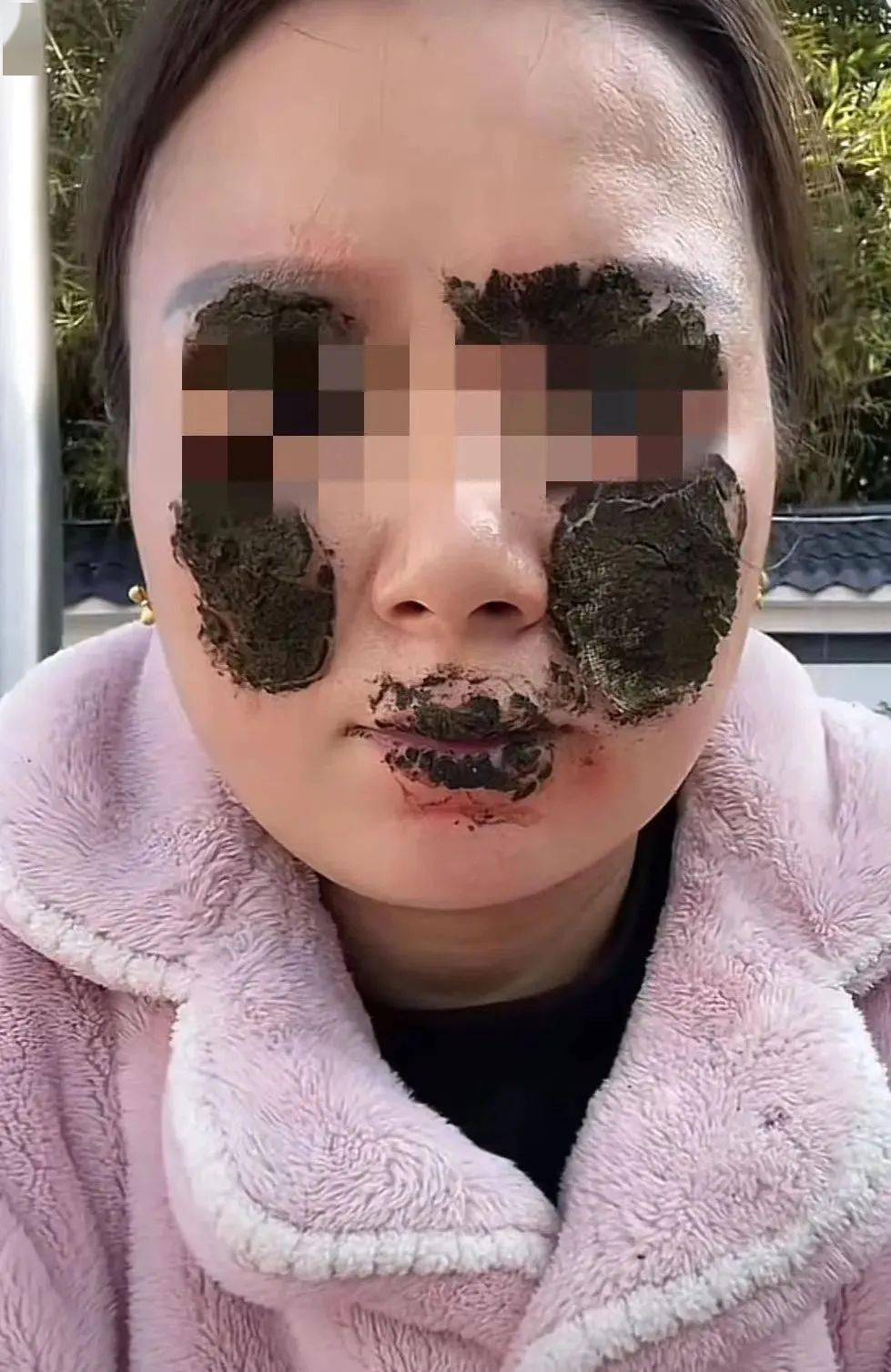 【100.6|天天讲安全】一新娘婚礼被毁容,竟因这个气氛道具