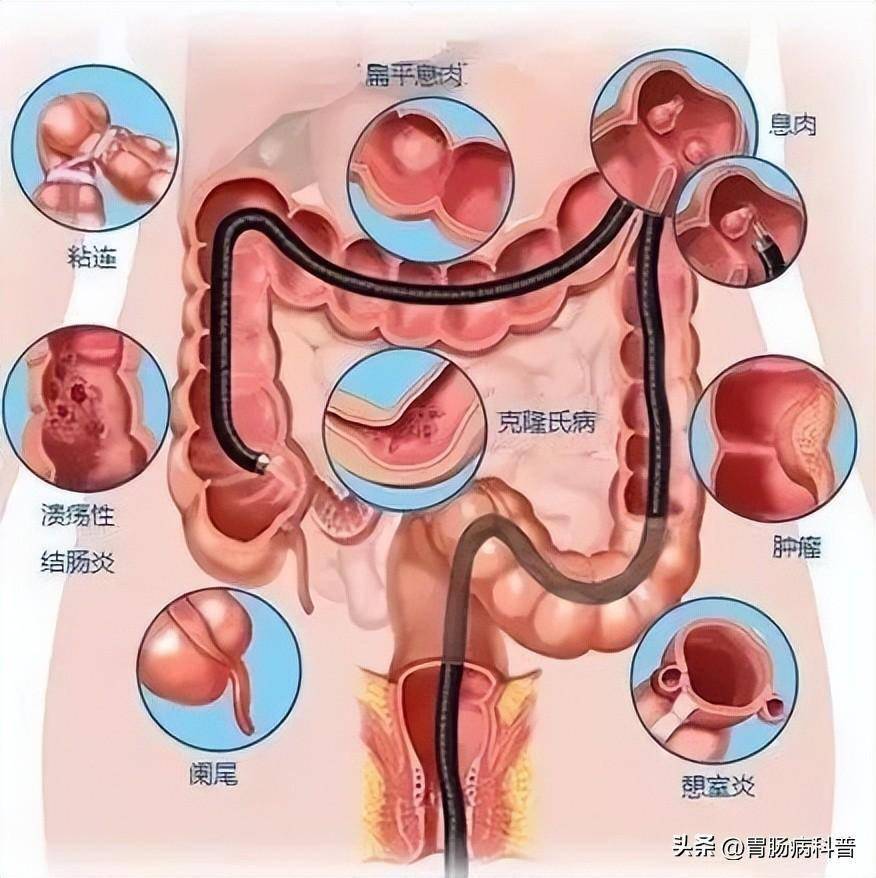 超全:胃鏡,結腸鏡,小腸鏡,超聲內鏡,無痛內鏡,膠囊