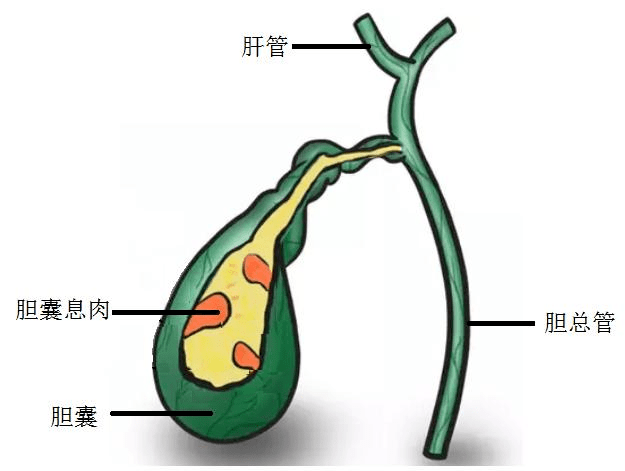 胆囊息肉b超图片